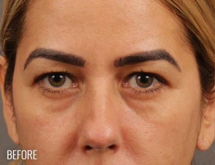 Brow Lift Before & After Patient #144