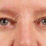 Brow Lift Before & After Patient #143