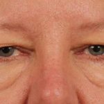 Brow Lift Before & After Patient #143