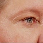 Brow Lift Before & After Patient #143