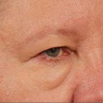Brow Lift Before & After Patient #143