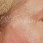 Brow Lift Before & After Patient #143
