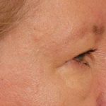 Brow Lift Before & After Patient #143