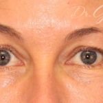 Brow Lift Before & After Patient #111
