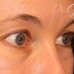 Brow Lift Before & After Patient #111
