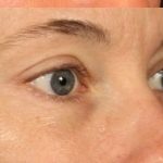 Brow Lift Before & After Patient #111
