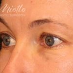 Brow Lift Before & After Patient #111