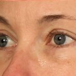 Brow Lift Before & After Patient #111