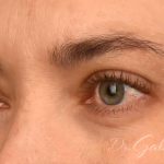 Brow Lift Before & After Patient #110