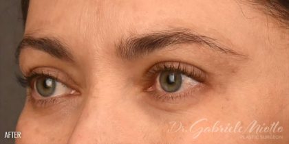 Brow Lift Before & After Patient #110