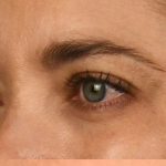 Brow Lift Before & After Patient #110