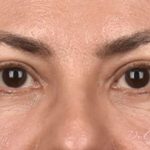 Blepharoplasty Before & After Patient #108
