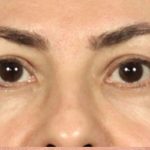 Blepharoplasty Before & After Patient #108