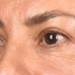Blepharoplasty Before & After Patient #108