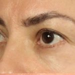 Blepharoplasty Before & After Patient #108
