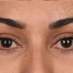 Brow Lift Before & After Patient #107