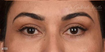 Brow Lift Before & After Patient #107