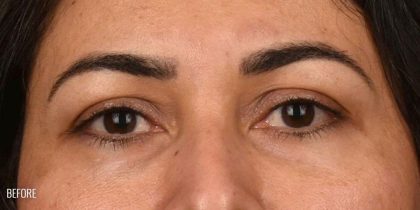 Brow Lift Before & After Patient #107