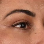 Brow Lift Before & After Patient #107