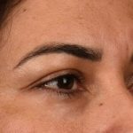 Brow Lift Before & After Patient #107