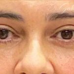 Blepharoplasty Before & After Patient #703