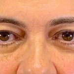 Blepharoplasty Before & After Patient #703
