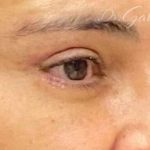 Blepharoplasty Before & After Patient #703