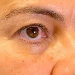 Blepharoplasty Before & After Patient #703