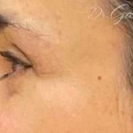 Blepharoplasty Before & After Patient #703