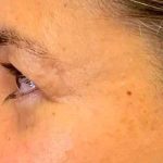 Blepharoplasty Before & After Patient #703
