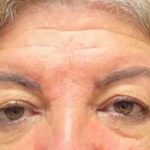 Blepharoplasty Before & After Patient #702