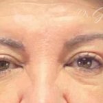 Blepharoplasty Before & After Patient #702