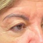 Blepharoplasty Before & After Patient #702