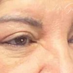 Blepharoplasty Before & After Patient #702