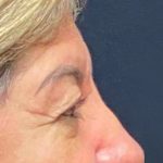 Blepharoplasty Before & After Patient #702