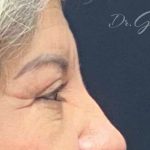Blepharoplasty Before & After Patient #702