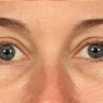 Blepharoplasty Before & After Patient #698