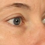 Blepharoplasty Before & After Patient #698