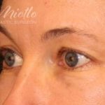 Blepharoplasty Before & After Patient #698