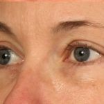 Blepharoplasty Before & After Patient #698