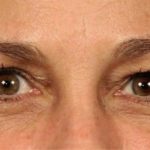 Blepharoplasty Before & After Patient #697