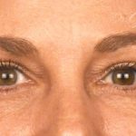 Blepharoplasty Before & After Patient #697
