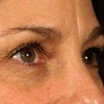 Blepharoplasty Before & After Patient #697