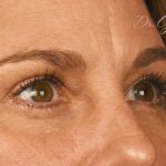 Blepharoplasty Before & After Patient #697