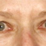 Blepharoplasty Before & After Patient #696