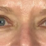 Blepharoplasty Before & After Patient #696