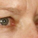 Blepharoplasty Before & After Patient #696