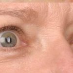 Blepharoplasty Before & After Patient #696