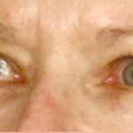 Blepharoplasty Before & After Patient #696