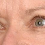 Blepharoplasty Before & After Patient #696